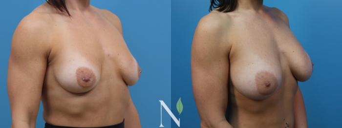 Before & After Breast Augmentation Case 183 Right Oblique View in Raleigh, NC