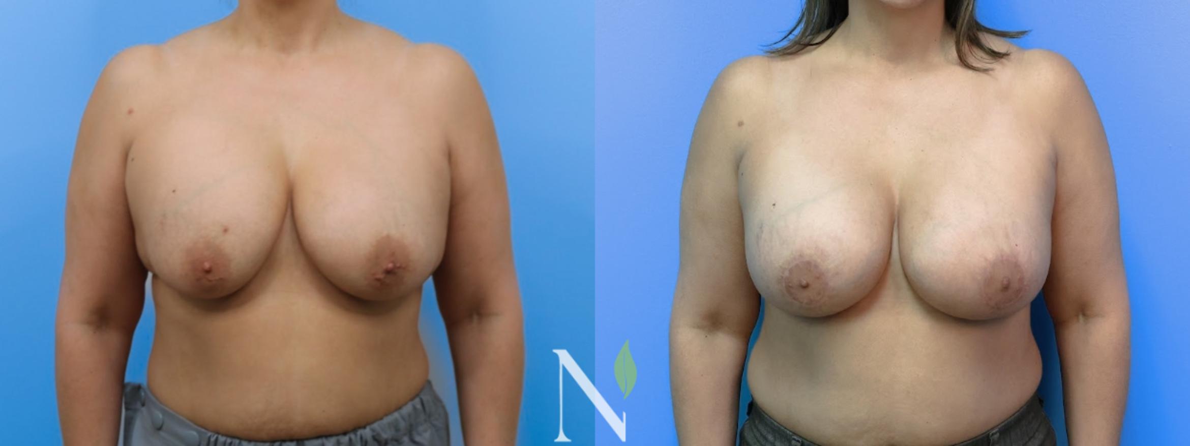 Before & After Breast Augmentation Case 184 Front View in Raleigh, NC