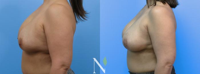 Before & After Breast Augmentation Case 184 Left Side View in Raleigh, NC
