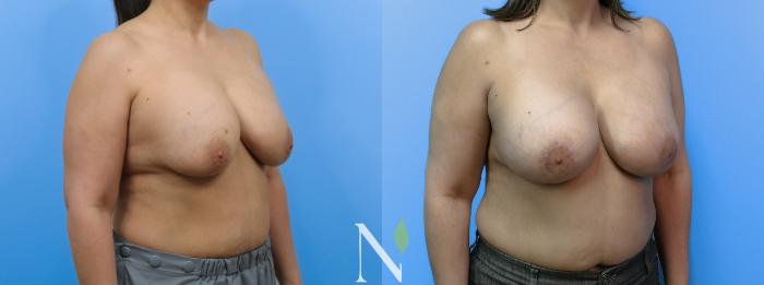 Before & After Breast Augmentation Case 184 Right Oblique View in Raleigh, NC