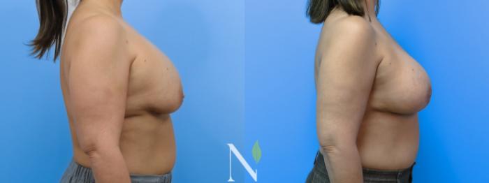 Before & After Breast Augmentation Case 184 Right Side View in Raleigh, NC