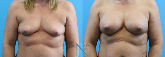 Before & After Breast Augmentation Case 19 View 1 View in Raleigh, NC