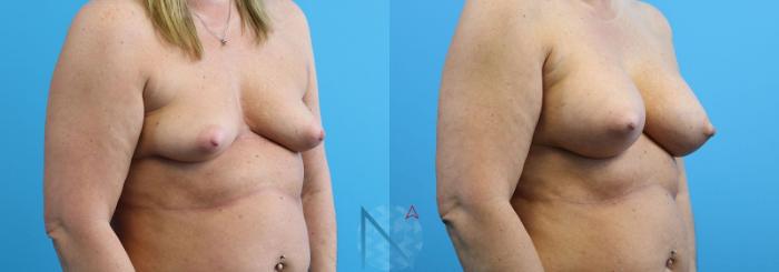 Before & After Breast Augmentation Case 19 View 2 View in Raleigh, NC