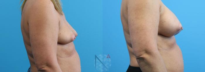 Before & After Breast Augmentation Case 19 View 3 View in Raleigh, NC