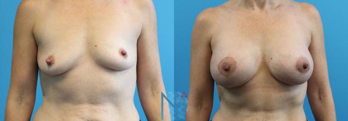 Before & After Breast Augmentation Case 20 View 1 View in Raleigh, NC