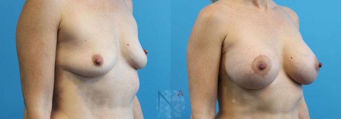 Before & After Breast Augmentation Case 20 View 2 View in Raleigh, NC