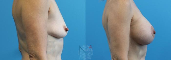 Before & After Breast Augmentation Case 20 View 3 View in Raleigh, NC