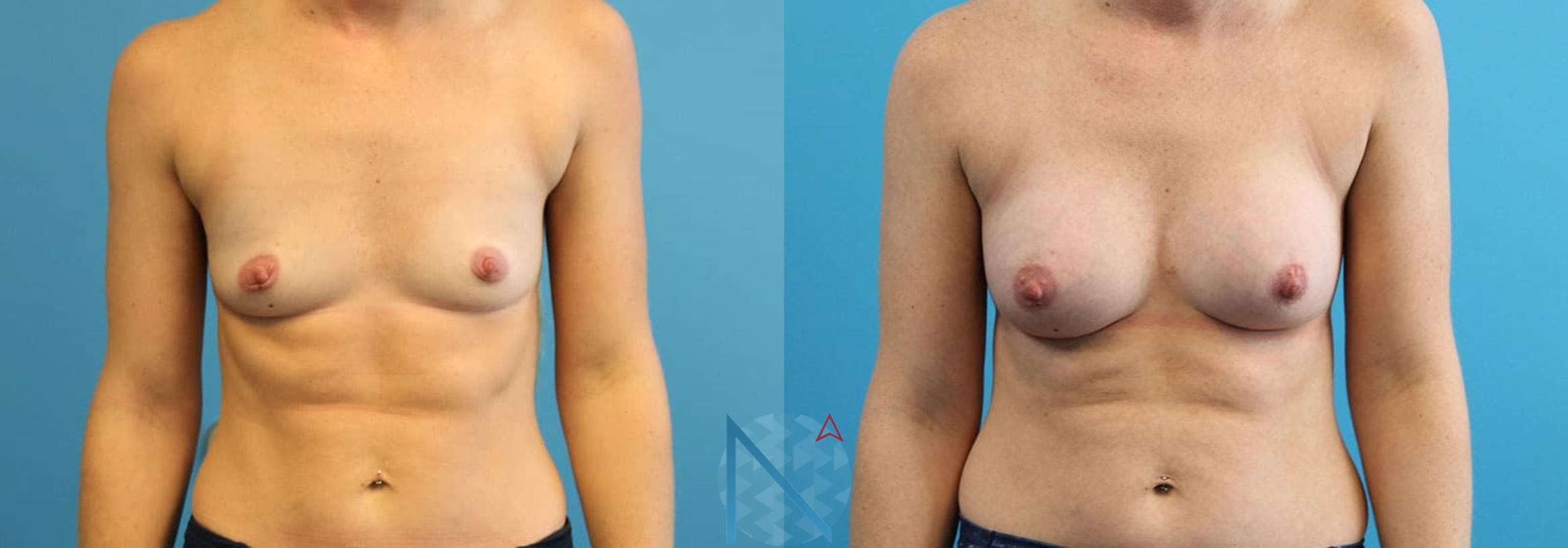 Before & After Breast Augmentation Case 21 View 1 View in Raleigh, NC