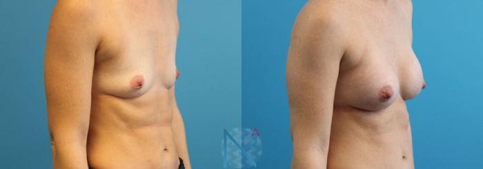 Before & After Breast Augmentation Case 21 View 2 View in Raleigh, NC