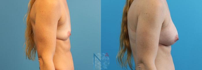 Before & After Breast Augmentation Case 21 View 3 View in Raleigh, NC