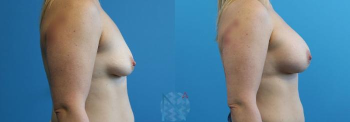 Before & After Breast Augmentation Case 22 View 3 View in Raleigh, NC