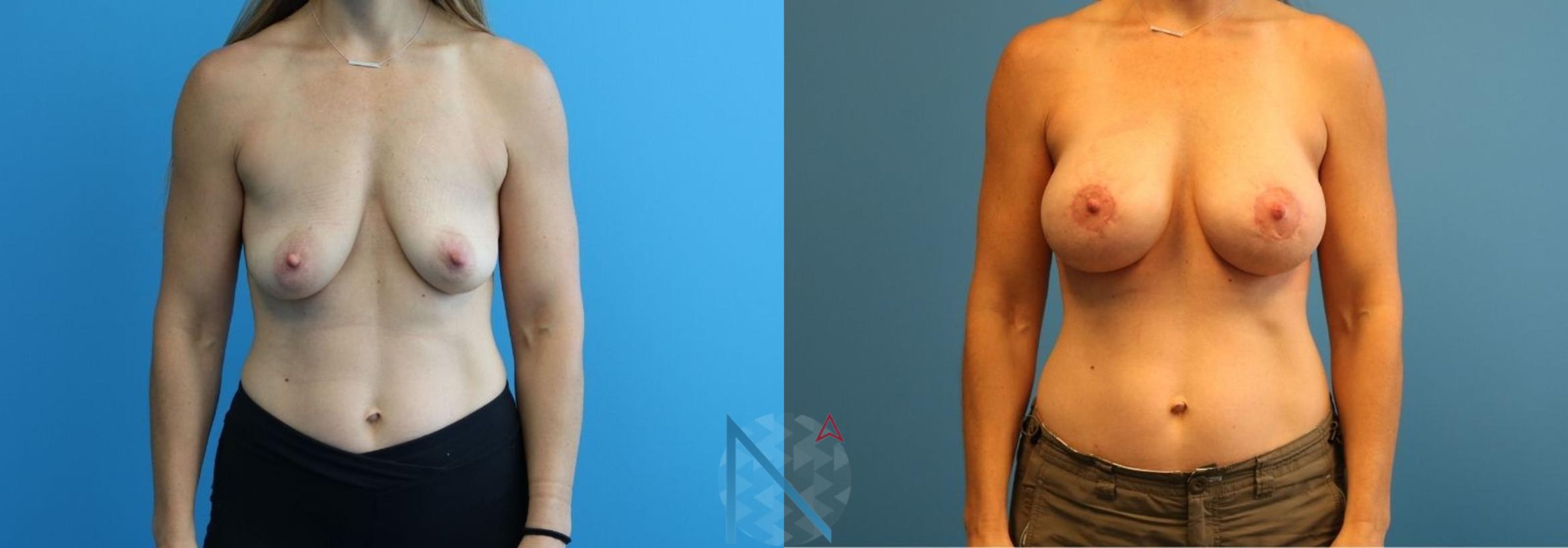 Before & After Breast Augmentation Case 23 View 1 View in Raleigh, NC