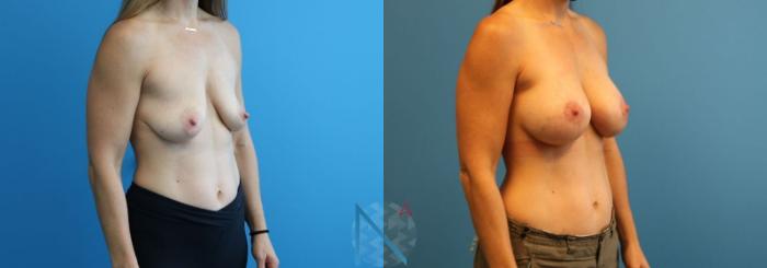 Before & After Breast Augmentation Case 23 View 2 View in Raleigh, NC