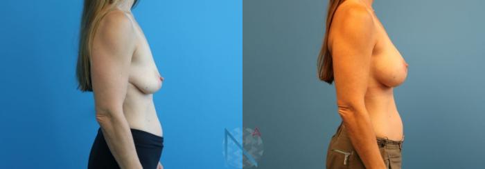 Before & After Breast Augmentation Case 23 View 3 View in Raleigh, NC