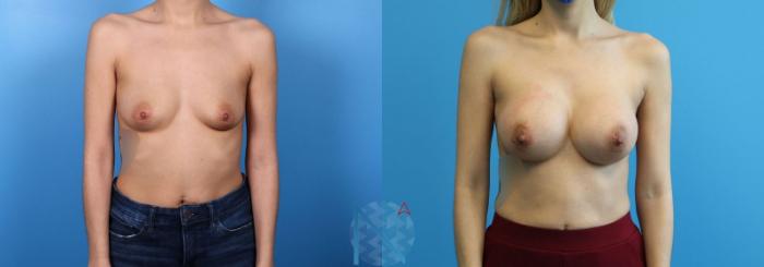 Before & After Breast Augmentation Case 24 View 1 View in Raleigh, NC