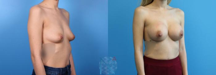 Before & After Breast Augmentation Case 24 View 2 View in Raleigh, NC