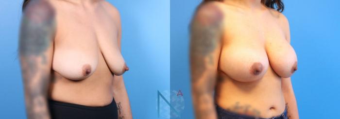 Before & After Breast Augmentation Case 25 View 2 View in Raleigh, NC