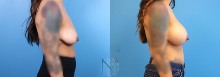 Before & After Breast Augmentation Case 25 View 3 View in Raleigh, NC