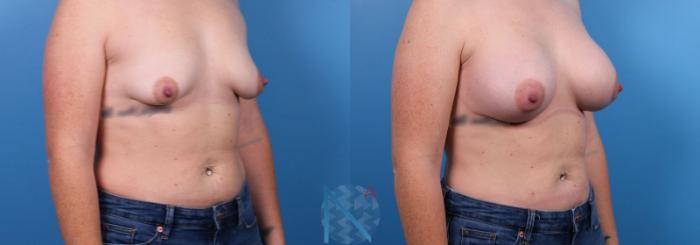 Before & After Breast Augmentation Case 26 View 2 View in Raleigh, NC