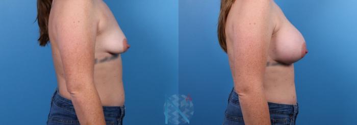 Before & After Breast Augmentation Case 26 View 3 View in Raleigh, NC