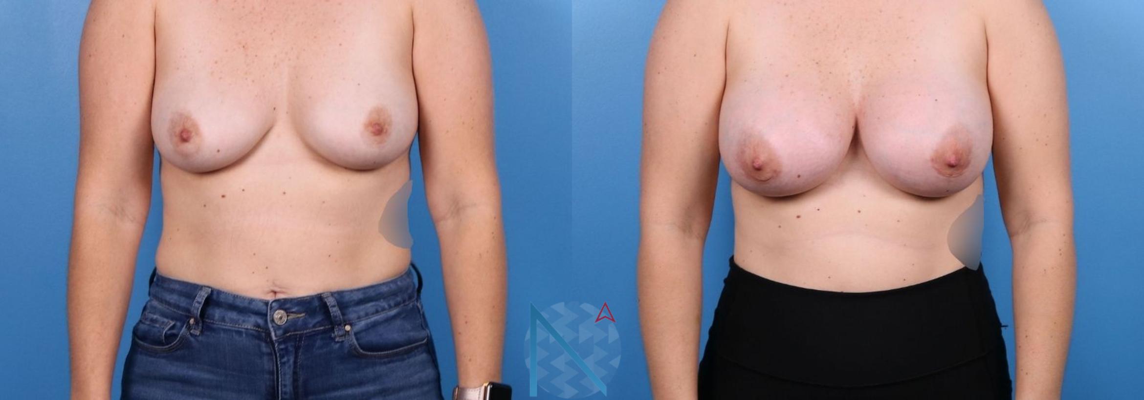 Before & After Breast Augmentation Case 27 View 1 View in Raleigh, NC