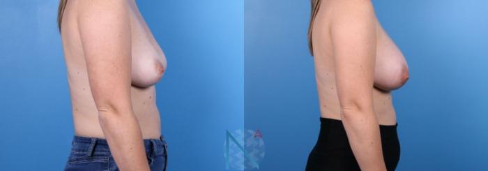 Before & After Breast Augmentation Case 27 View 3 View in Raleigh, NC