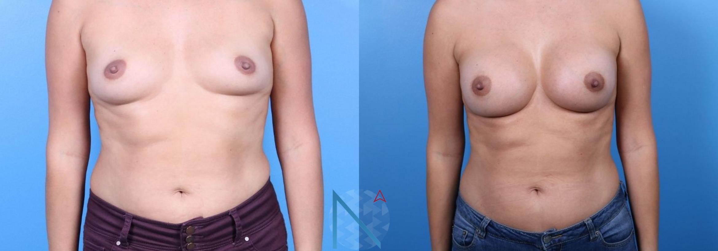 Before & After Breast Augmentation Case 28 View 1 View in Raleigh, NC