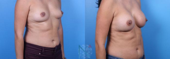 Before & After Breast Augmentation Case 28 View 2 View in Raleigh, NC