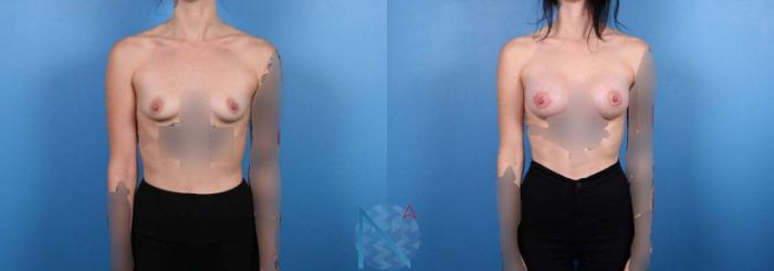 Before & After Breast Augmentation Case 29 View 1 View in Raleigh, NC