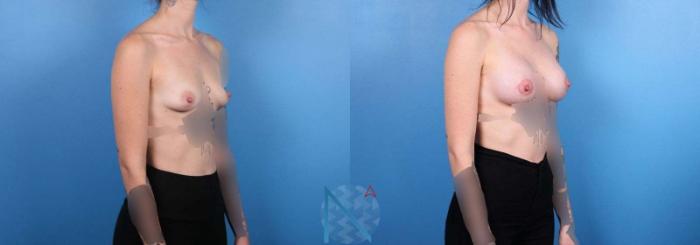 Before & After Breast Augmentation Case 29 View 2 View in Raleigh, NC