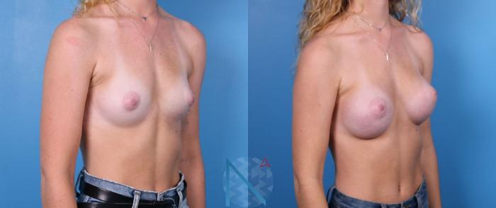 Before & After Breast Augmentation Case 30 View 2 View in Raleigh, NC