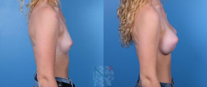 Before & After Breast Augmentation Case 30 View 3 View in Raleigh, NC