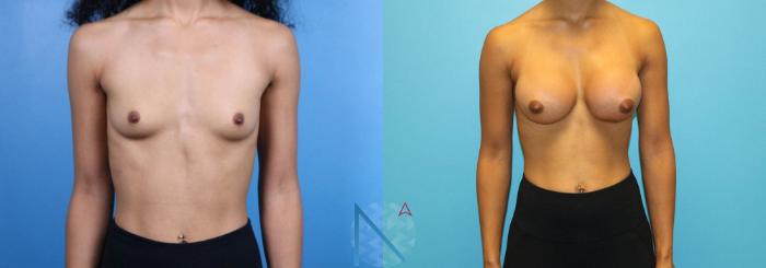 Before & After Breast Augmentation Case 32 View 1 View in Raleigh, NC