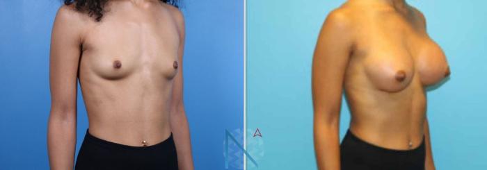 Before & After Breast Augmentation Case 32 View 2 View in Raleigh, NC