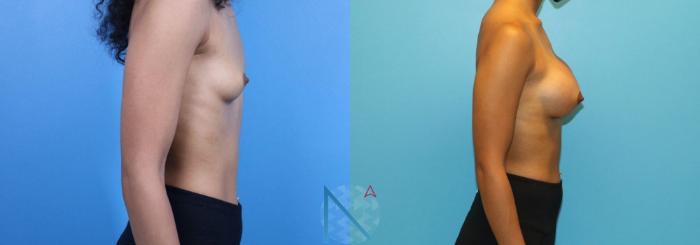 Before & After Breast Augmentation Case 32 View 3 View in Raleigh, NC