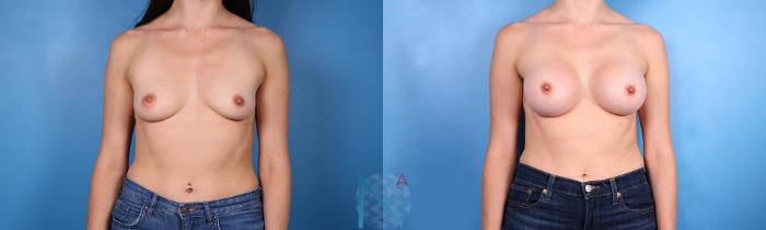 Before & After Breast Augmentation Case 33 View 1 View in Raleigh, NC