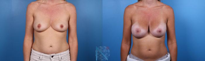 Before & After Breast Augmentation Case 34 View 1 View in Raleigh, NC