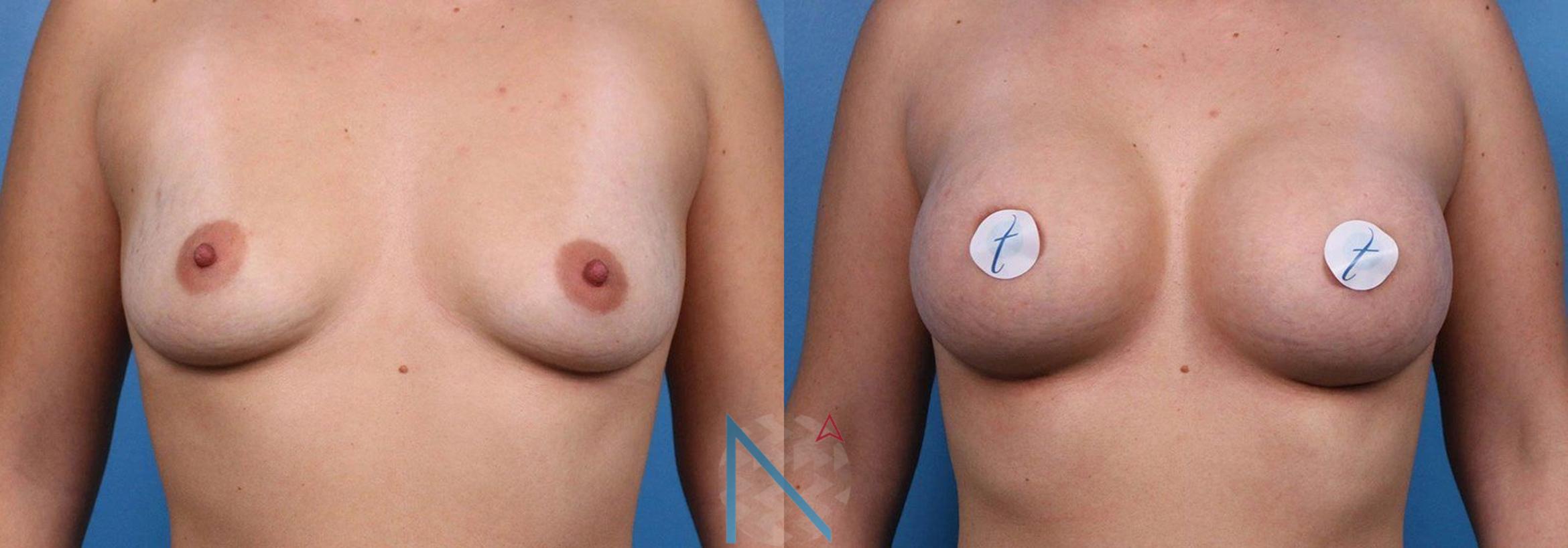 Before & After Breast Augmentation Case 35 View 1 View in Raleigh, NC