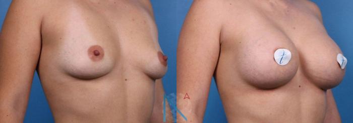 Before & After Breast Augmentation Case 35 View 2 View in Raleigh, NC