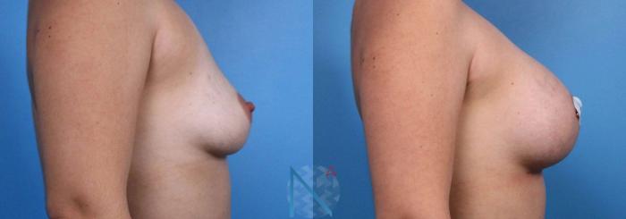 Before & After Breast Augmentation Case 35 View 3 View in Raleigh, NC