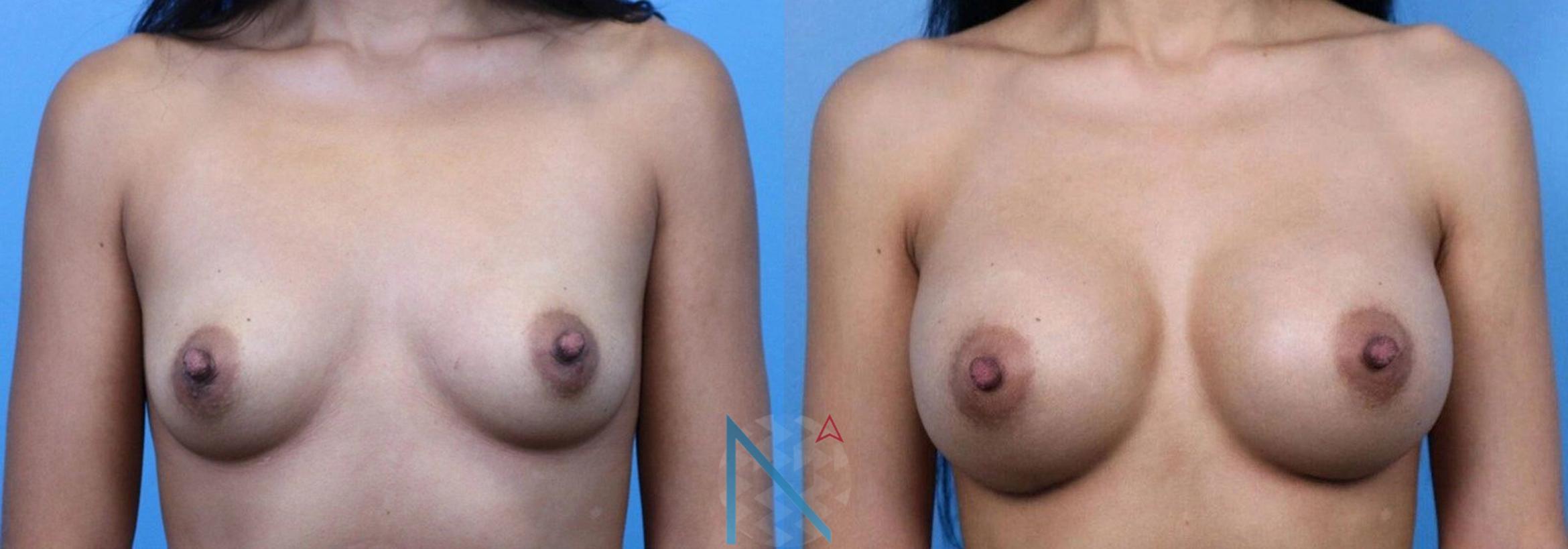 Before & After Breast Augmentation Case 36 View 1 View in Raleigh, NC