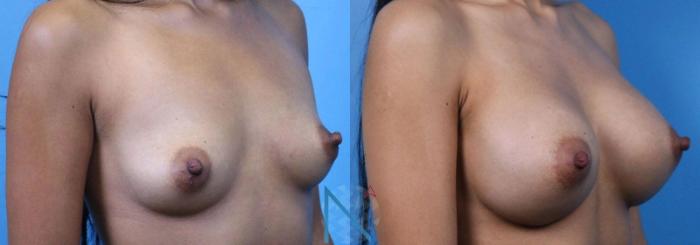 Before & After Breast Augmentation Case 36 View 2 View in Raleigh, NC