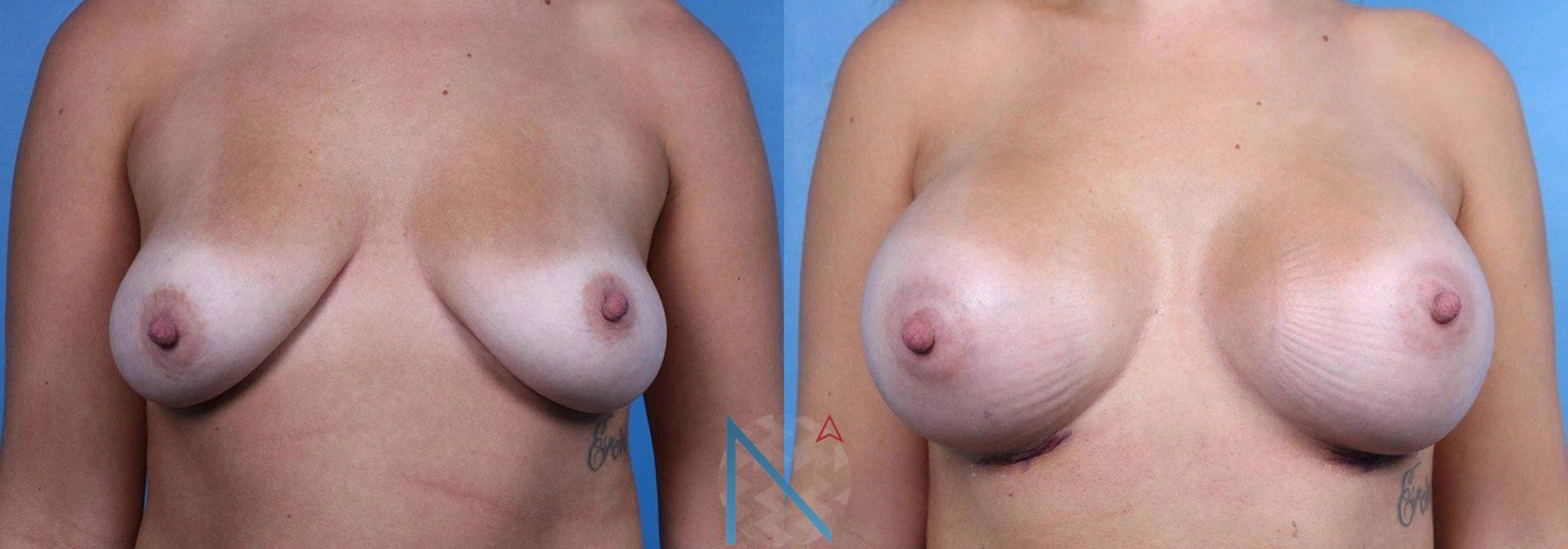 Before & After Breast Augmentation Case 37 View 1 View in Raleigh, NC