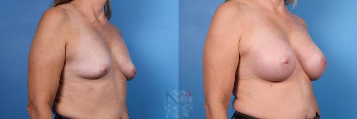 Before & After Breast Augmentation Case 38 View 2 View in Raleigh, NC