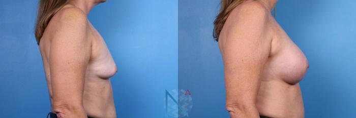 Before & After Breast Augmentation Case 38 View 3 View in Raleigh, NC