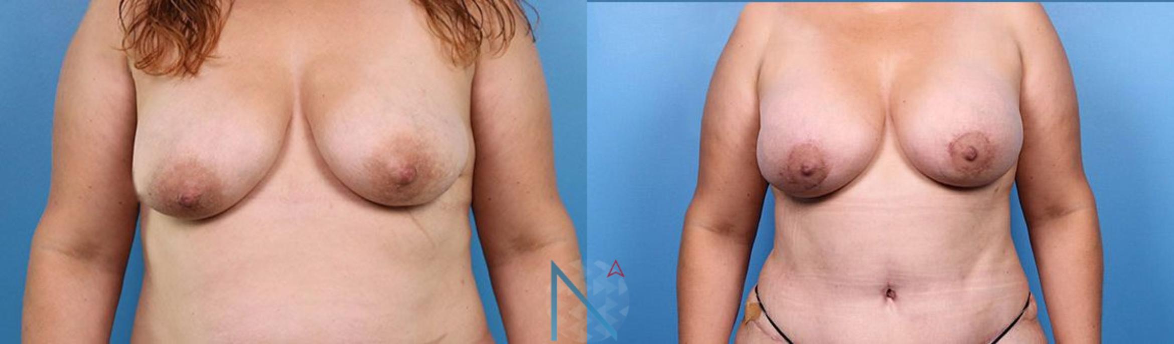 Before & After Breast Augmentation Case 39 View 1 View in Raleigh, NC