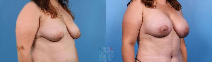 Before & After Breast Augmentation Case 39 View 2 View in Raleigh, NC