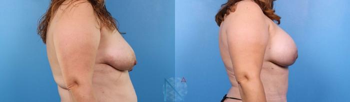 Before & After Breast Augmentation Case 39 View 3 View in Raleigh, NC