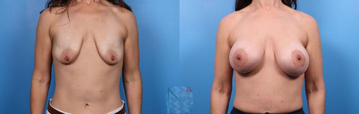 Before & After Breast Augmentation Case 40 View 1 View in Raleigh, NC