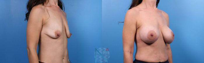 Before & After Breast Augmentation Case 40 View 2 View in Raleigh, NC